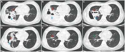 Pulmonary infection with Aeromonas dhakensis in a patient with acute T lymphoblastic leukemia: a case report and review of the literature